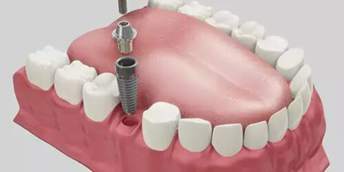 Dental-Implant