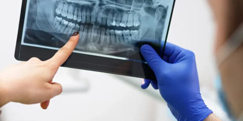 Dental-OPG-Digital-X-Ray