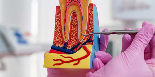 Root-Canal-Treatment