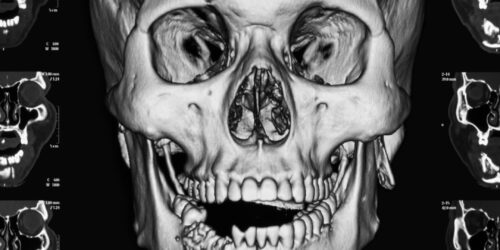 facial fractures